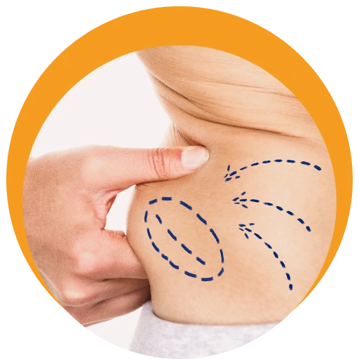 Liposuction