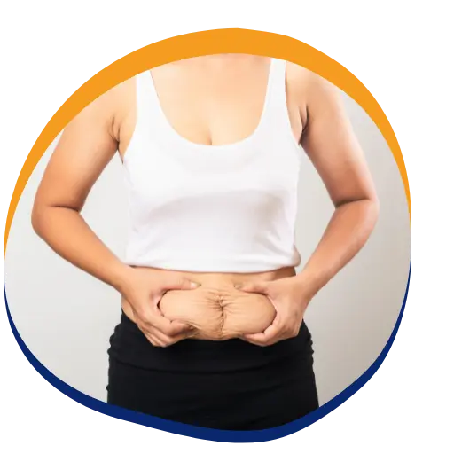 Tummy Tuck