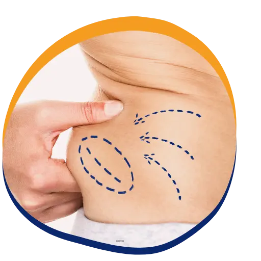 Liposuction